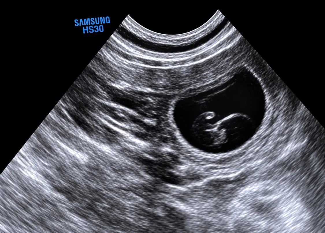 London & Malcolm’s puppies are on the way!, London's pregnancy ultrasound from September 29, 2026.